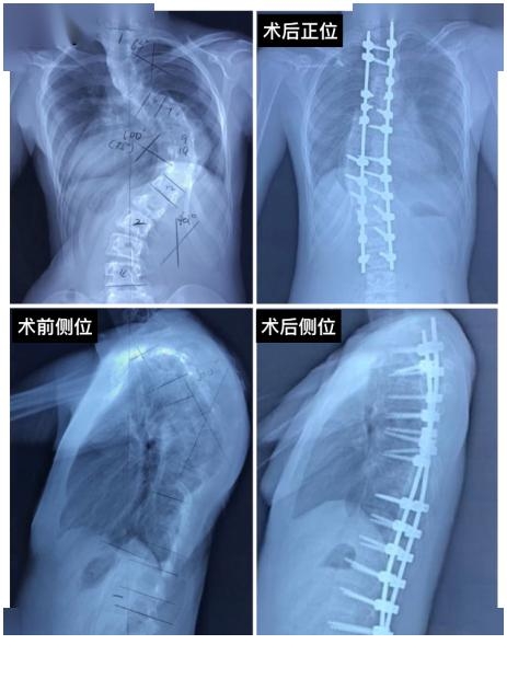 小儿麻醉医生写给脊柱侧弯小朋友的一封信