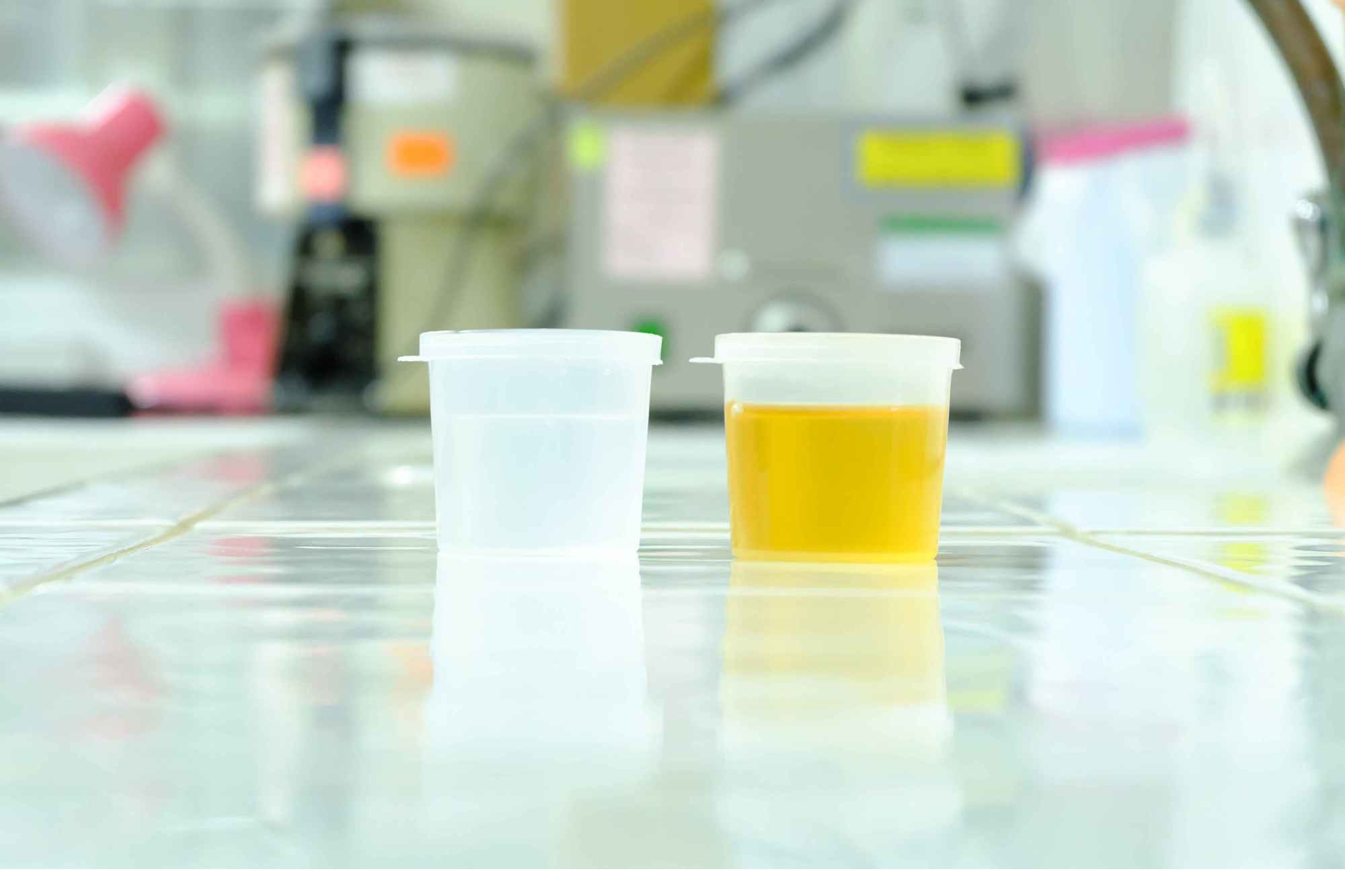 正常尿液是什么颜色?若不是这个颜色,需重视起来